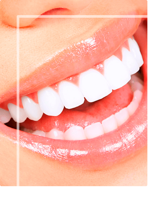 Lentes de Contato Dental em Belo Horizonte